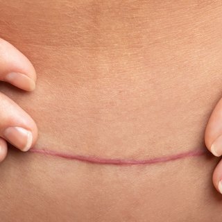 6 Of The Simplest C-Section Tips To Help You Recover Faster - Bullabaloo