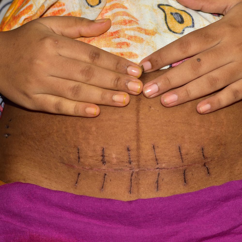 How Many Hours After a C-Section Can I Walk? A Guide to Postoperative Mobility - Bullabaloo